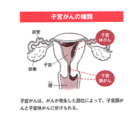 子宮がんの種類